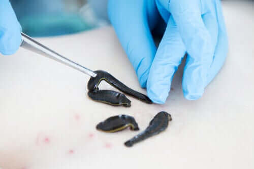 Blodigelns användning inom medicin som blodtappare.