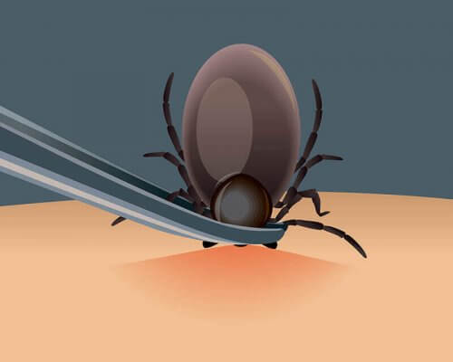Allt om borreliainfektioner: borttagning